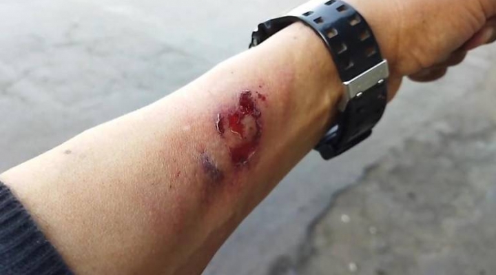 El periodista Nicolás Sanabria resultó herido en el conflicto de Adepcoca