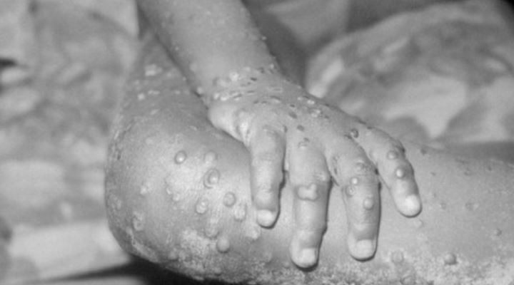  La viruela, la única enfermedad erradicada y qué lecciones dejó para enfrentar el Covid