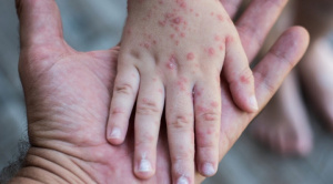 Salud reporta más de 300 casos sospechosos de sarampión en el país; prevé vacunación en escuelas