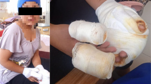 Adolescente de 14 años sufre quemaduras de primer y segundo grados; se inicia campaña de ayuda